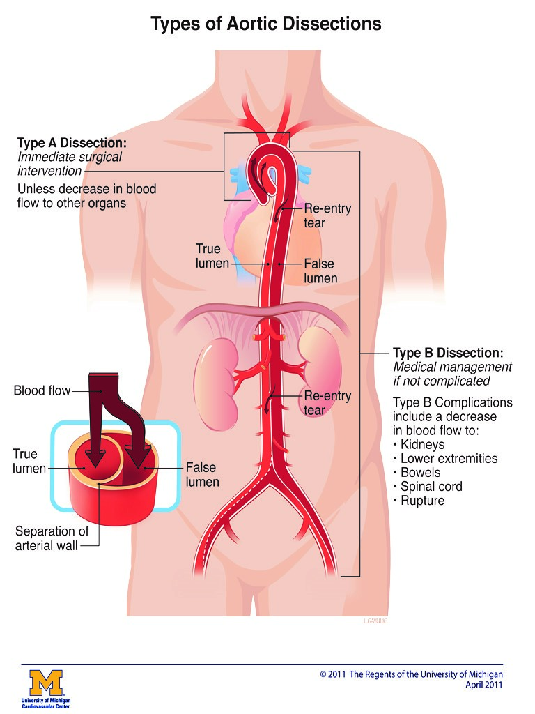 About Aortic Dissection Living With Aortic Dissection